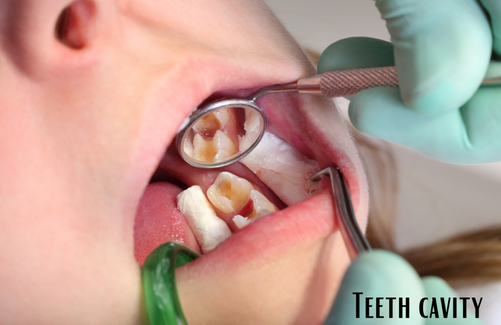 How Do Dentists Fill Cavities Between Teeth Medicon