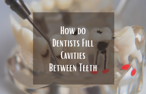 How do Dentists Fill Cavities Between Teeth