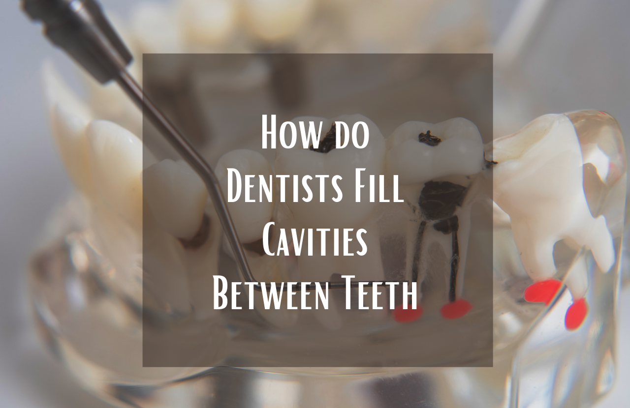 How do Dentists Fill Cavities Between Teeth
